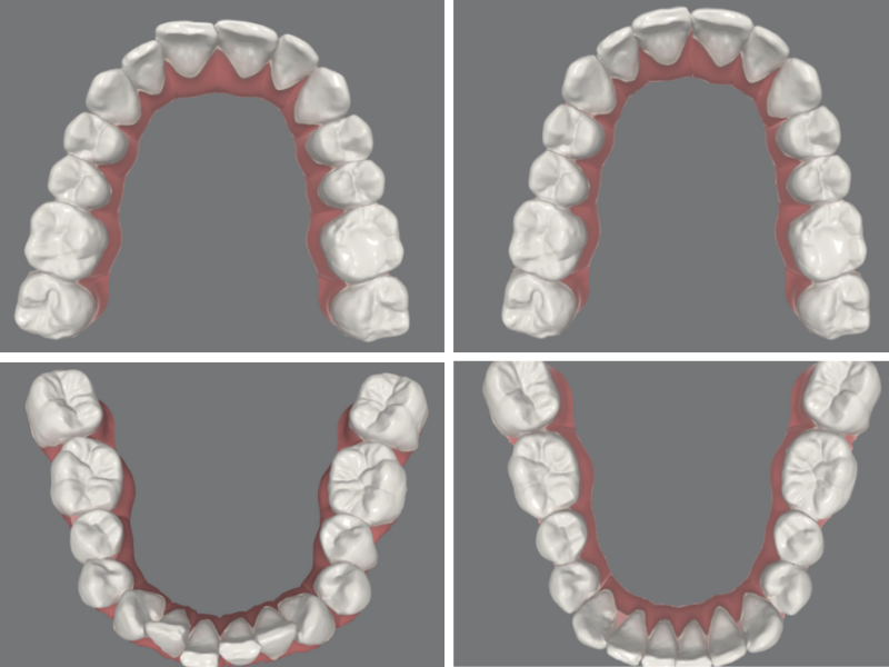 Visor dinamico de caso clínico con ortodoncia invisible en paciente con sonrisa alta y gingival