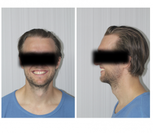 evaluacion inicial de arcadas caso clínico con ortodoncia invisible en paciente con sonrisa alta y gingival
