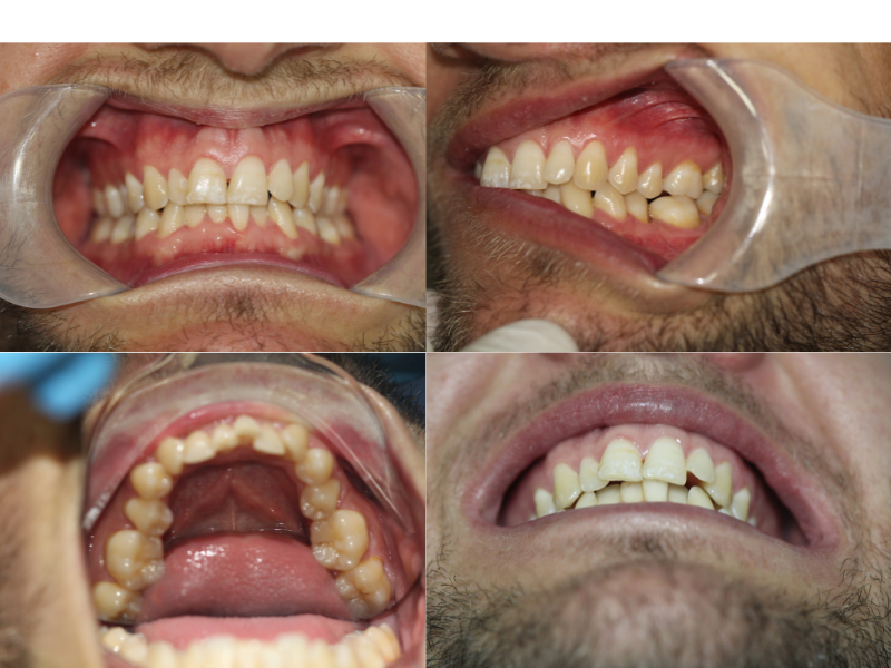 evaluacion inicial de arcadas caso clínico con ortodoncia invisible en paciente con sonrisa alta y gingival