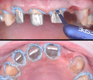 Aplicación de pasta de retracción astringente en los dientes