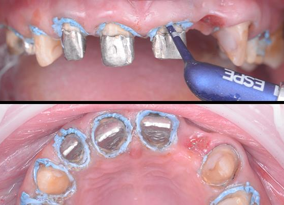 Aplicación de pasta de retracción astringente en los dientes