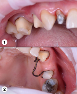 Métodos mecánicos para una una retracción gingival 