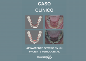 Apiñamiento severo en un paciente periodontal: CASO CLÍNICO