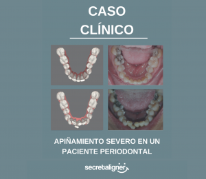 Apiñamiento severo en un paciente periodontal: caso clínico