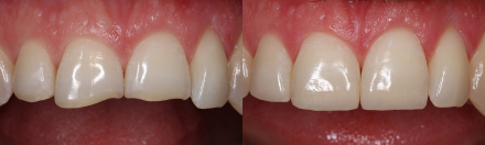 Antes y después, restauración composite dentsply