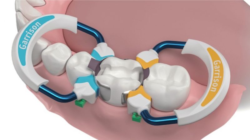 Una matriz dental es una banda que se adapta a la superficie del diente que va a ser restaurado y reproduce los contornos anatómicos