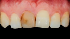 La revolución estética en restauraciones dentales: Descubre el poder de Ceram.X Spectra ST