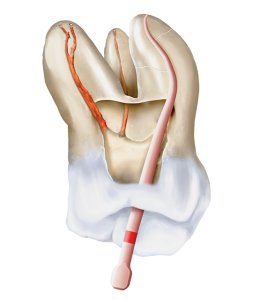 Sellado biocompatible y ajuste óptimo tanto con una técnica de obturación en frío o termoplástica.